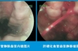 上消化道大出血是肝硬化的严重并发症