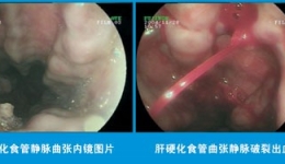 上消化道大出血是肝硬化的严重并发症