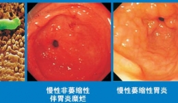 慢性胃炎与胃癌的关系