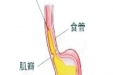 胃食管反流病知识