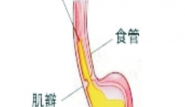 胃食管反流病知识