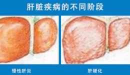 慢性肝病小常识