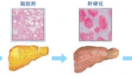 您应该知道的脂肪肝知识