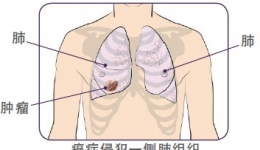 肺癌的手术治疗
