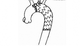 我院首次成功运用“烟囱”技术开展主动脉夹层介入手术