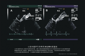 希氏束起搏电极置放