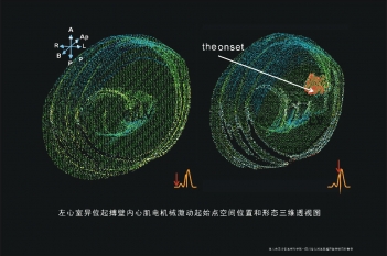 左心室异位起搏