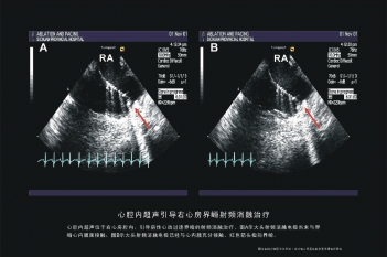 右心房界嵴射频消融