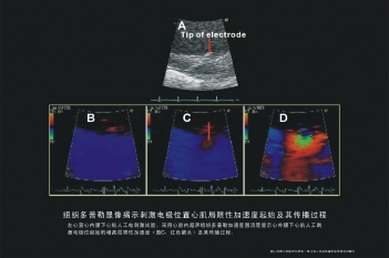 电极位置心肌局限性加速