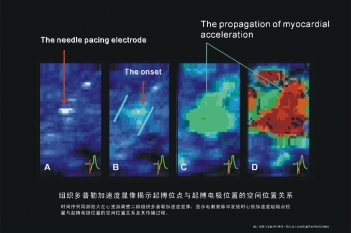 起搏位点与起搏电极位置的关系
