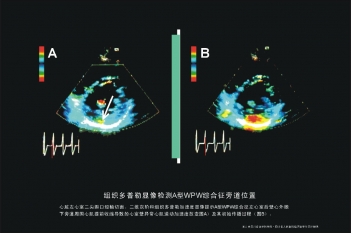 A型WPW综合症旁道位置