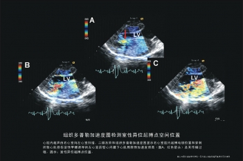 室性异位起搏点空间位置