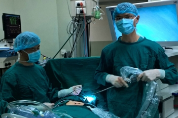 首例经剑突下单孔胸腔镜双侧肺大疱切除术