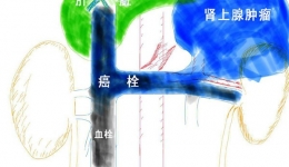 我省首例肾上腺肿瘤合并下腔静脉癌栓疑难手术顺利完成