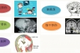 科学康复摆脱脑外伤后遗症