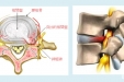 腰椎间盘突出症康复治疗