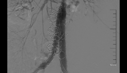 我院运用介入手术成功抢救一例腹主动脉瘤急性破裂出血患者