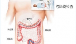 如何早期发现和治疗大肠癌