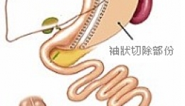 肥胖与2型糖尿病外科手术治疗