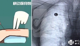 集团崇州医院成功开展崇州首例经桡动脉入路全脑血管造影术