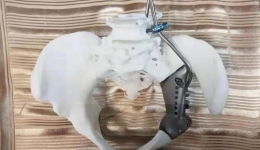 四川观察：盆骨也能“私人定制” 省医院完成3D打印半骨盆手术