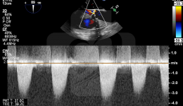 多科合作，我院完成首例经皮主动脉瓣置换术