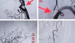 集团崇州医院成功开展首例颈动脉和椎动脉支架置入术