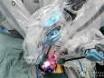 机器人微创中心完成西部首例单孔机器人前列腺癌根治术
