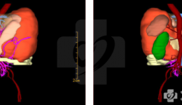 器官移植中心成功完成腹腔巨大肿瘤联合多器官切除术