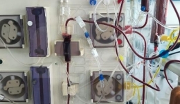 肾脏内科联合器官移植中心开展血浆透析滤过技术治疗爆发性肝衰竭合并急性肾衰竭