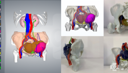 胃肠外科与医学3D打印中心医工结合实施肿瘤精准切除