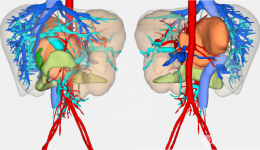 器官移植中心成功完成腹膜后巨大肿瘤联合肠系膜上动脉切除异体血管移植术