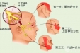 三叉神经痛病因及治疗