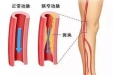 腿脚疼痛、麻木、发凉？警惕下肢动脉硬化闭塞症！