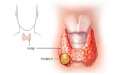 如何面对乘风破浪的甲状腺结节？