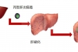 丙型病毒性肝炎