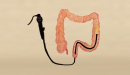 肠道内镜检查和手术，术前准备这样做！