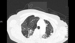 胸外科成功开展充气式纵隔镜食管癌切除术