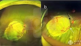 多学科联合完成首例视网膜母细胞瘤超选眼动脉介入灌注化疗