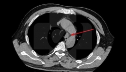 我院成功开展首例充气式纵隔镜异位甲状旁腺肿瘤切除术