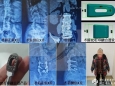骨科利用3D打印个性化钛合金腰椎椎间融合器治疗腰椎退变性侧凸畸形