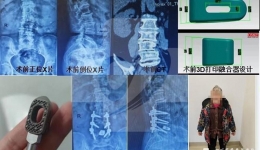 骨科利用3D打印个性化钛合金腰椎椎间融合器治疗腰椎退变性侧凸畸形