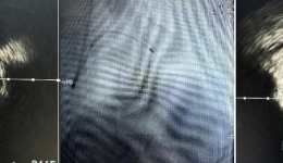 集团崇州医院开展崇州首例血管内超声和冠状动脉旋磨术