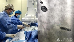 集团崇州医院成功开展无导线心脏起搏器植入手术