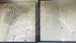 我院成功开展首例心脏收缩力调节器植入手术