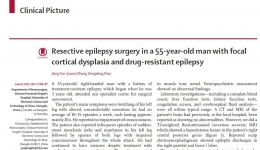 我院神经外科癫痫团队在医学顶级杂志《柳叶刀》正刊The Lancet上发表病例报道