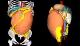 成都日报锦观新闻：省医院成功为13岁女孩切除5公斤巨大肿瘤