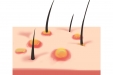 皮肤也会感染HPV