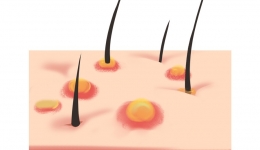 皮肤也会感染HPV