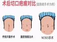 成都日报锦观新闻：全省首例！治疗直肠癌不切肚子、不“挂袋”